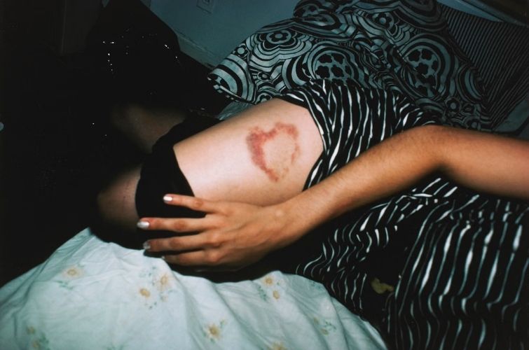 Heart-shaped bruise, New York City, 1980, Nan Goldin